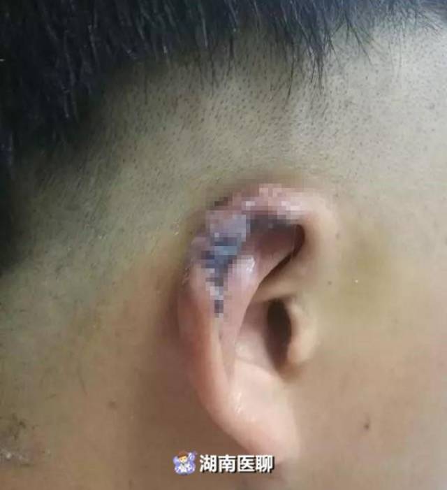 男子与人起争执,一块耳朵被咬掉,吓晕了