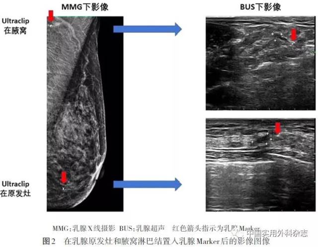 专题笔谈|可视化经皮穿刺乳腺病灶定位标记夹的临床应用