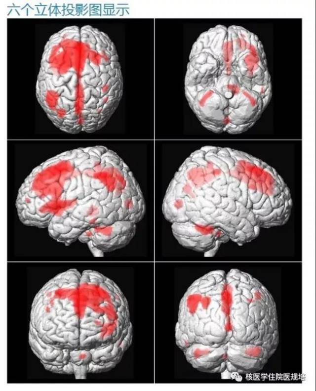 脑灰质及神经核团fdg代谢不均匀减低,以左侧额叶,顶叶及丘脑代谢减低