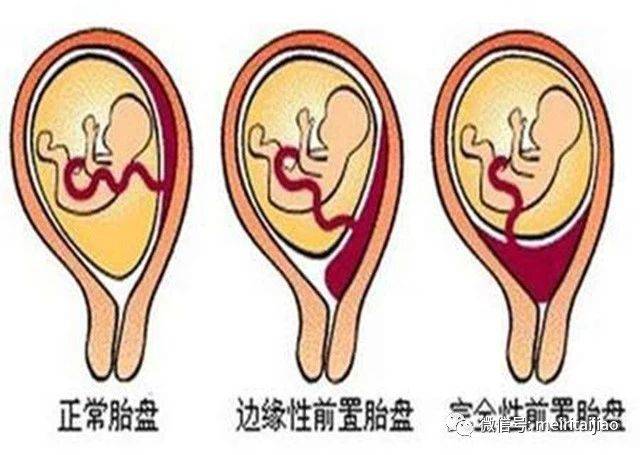 怀孕七个多月,胎盘位置后壁ii级是什么意思