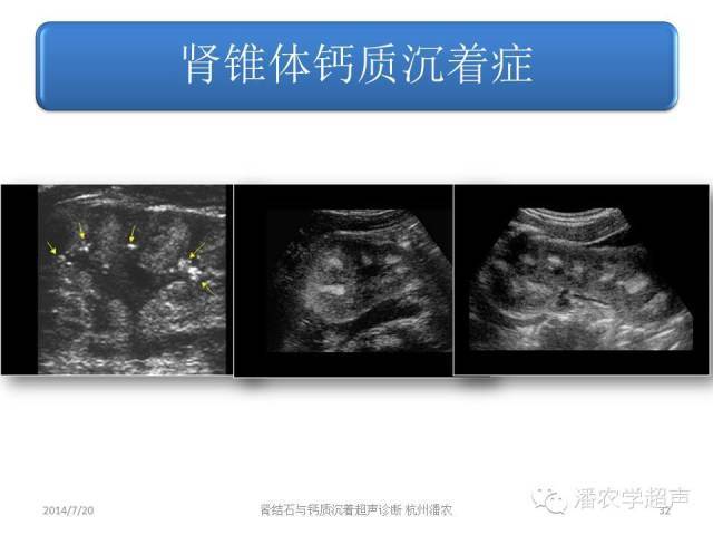 【超声微课堂】肾结石和肾钙质沉着症超声表现的异同之二