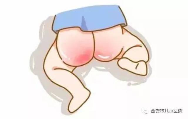 臀部等处,严重者可蔓延至男婴的阴囊,女婴的大阴唇,大腿内侧,腰骶部)