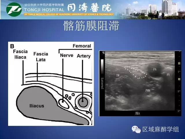 腰丛神经阻滞的临床应用