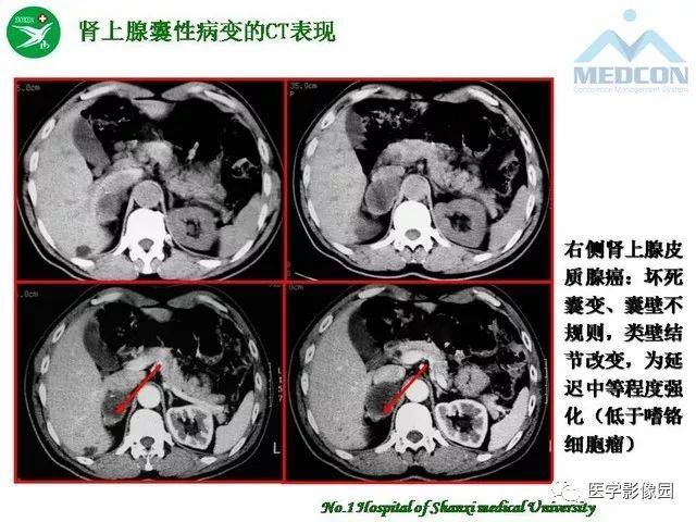 肾上腺囊性病变的msct表现 | 影像天地