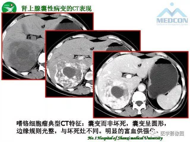 肾上腺囊性病变的msct表现 | 影像天地