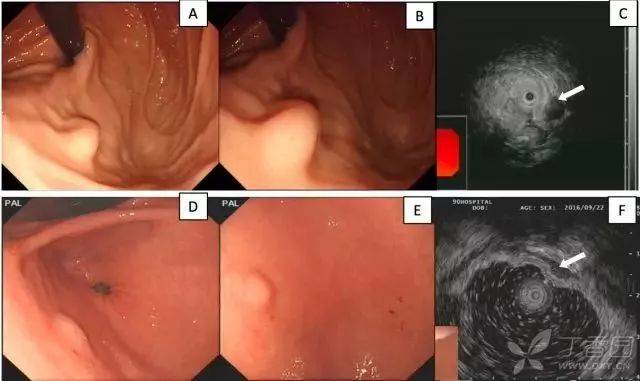 胃镜报告胃粘膜下隆起,是什么病?