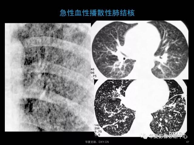 肺炎,肺结核,肺癌在ct及胸片上的区别