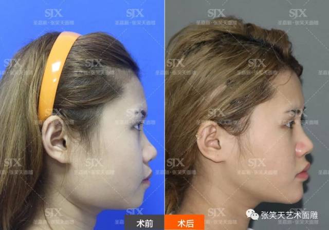 颧骨颧弓双端点内推术后1个月