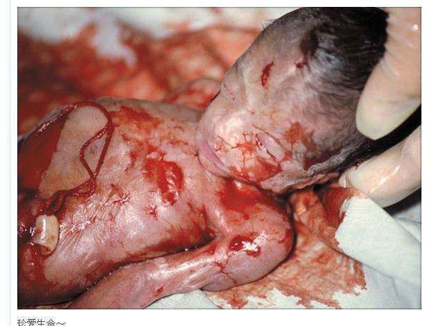 堕胎取出的东西,就像看到别人的儿子和女儿!