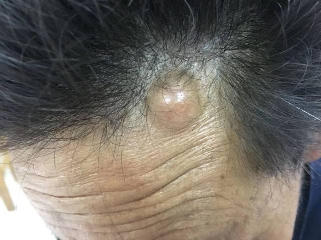 5 一站式服务 完成中心与站内的预约转诊 小梅村的姚大爷额头的囊肿