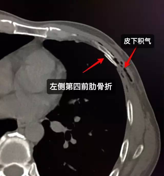 病例3:男,45岁,外伤 ct证实左侧第四肋骨骨折,局部积气.