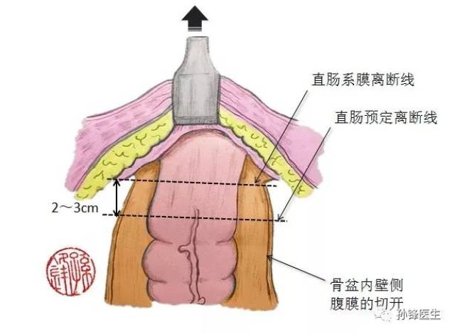 医学笔记|肠管吻合前,肠管壁游离几厘米为宜?(锋哥手绘图)