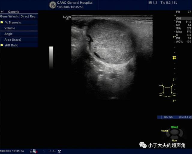 超声所见:右侧腮腺中部可见中低回声,大小约2.8×2.