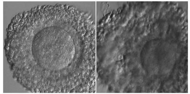 左图:显微镜下未成熟卵子被卵丘细胞紧密包裹 右图:成熟卵子,卵丘细胞