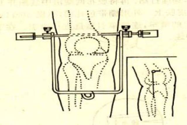 操作简捷,胫骨结节牵引较股骨髁上牵引更常用)  穿刺部位:胫骨结节