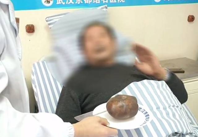 男子隐私部位长出"鸵鸟蛋!和这个爱好有关