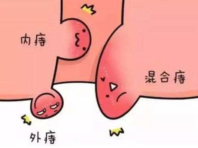 女性若发生痔疮出血可以引发病菌繁殖,而这