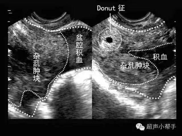 异位妊娠破裂型声像