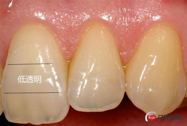 透明度最低的是饱和区.主要分布在牙颈部和牙体中部靠颈部的区域.
