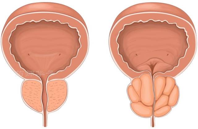 前列腺钙化了有啥影响?能导致什么后果,应该怎