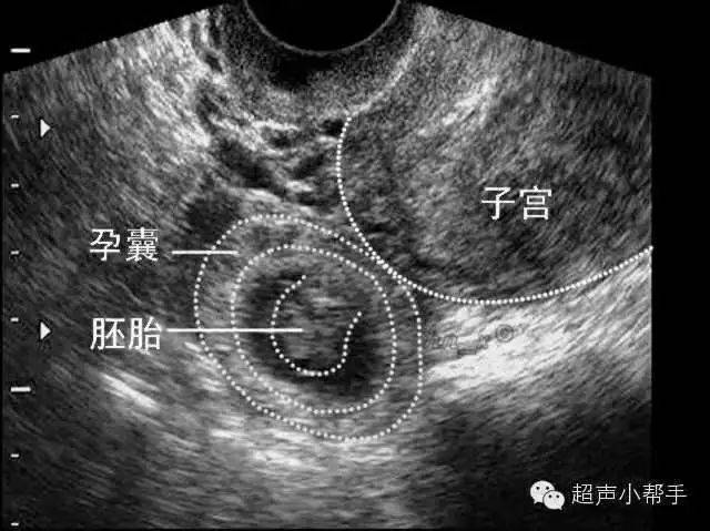 妇产科医生必备干货:异位妊娠的超声表现,最全图解!(上篇)