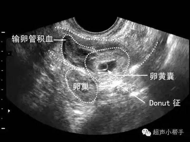 妇产科医生必备干货:异位妊娠的超声表现,最全图解(上篇)