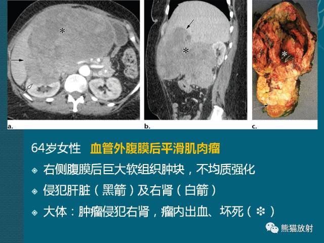 腹膜后平滑肌肉瘤丨诊断及鉴别诊断