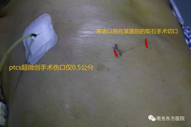 术后只放置一根如筷子大小的胆道引流管,腹部无其他伤口