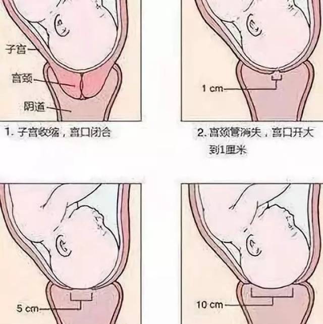 产妇准备 宫颈从0开到3指,速度比较慢,这个阶段孕妇可以吃一点食物