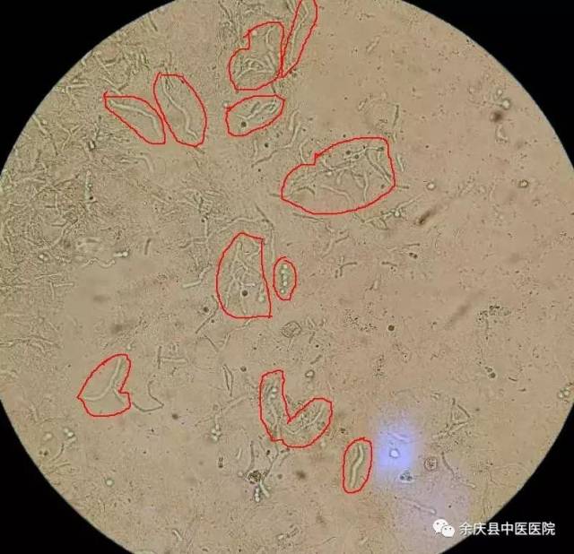 皮肤真菌镜检影像:大量透明菌丝,许多呈分支状菌丝,有的可见分隔