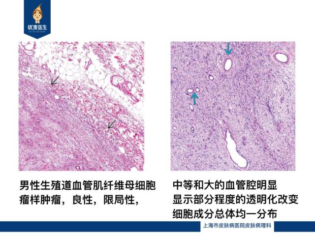 本期课程中,我们将围绕细胞型血管纤维瘤进行研究,欢迎大家一起讨论与