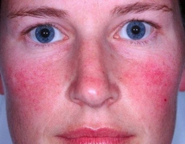 玫瑰痤疮它是发生在面部,以鼻部为中心的,表现为面中部的红斑,潮红