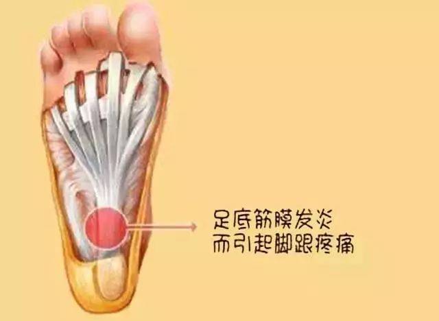 【健康生活】足底痛?你的脚是怎么了?