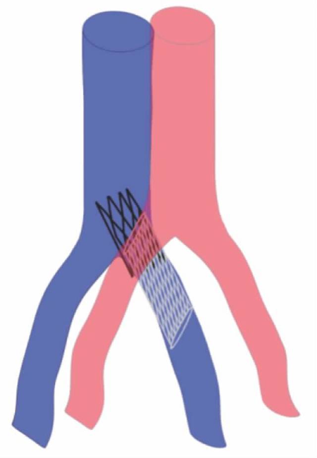 【前沿技术】髂静脉支架进入下腔静脉长度的探讨