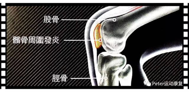 跑者膝/髌前滑囊炎/膝关节前侧疼——不科学地跑早晚要中招