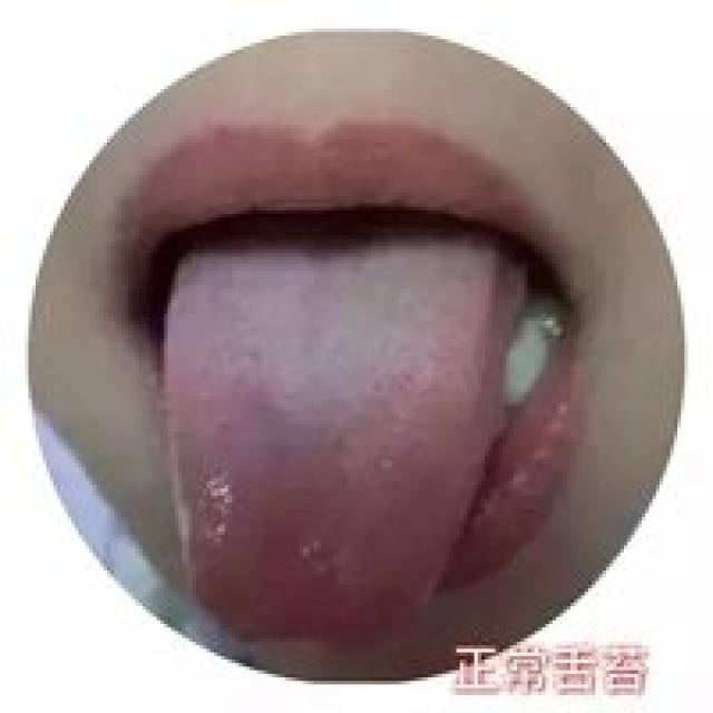 正常舌苔 健康孩子的舌质颜色是粉红色,上面有一层薄薄的舌苔.