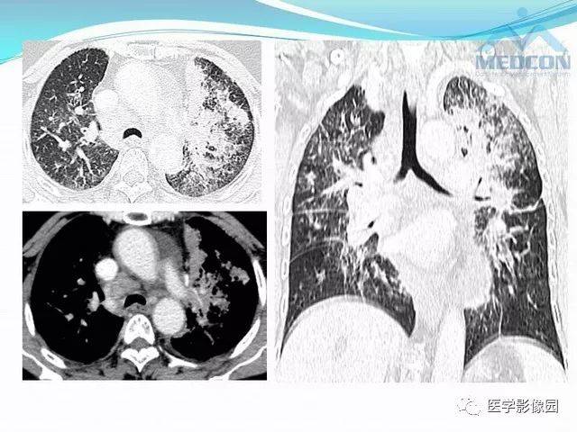 "肺炎型"肺癌的ct表现及病理学基础 | 影像天地