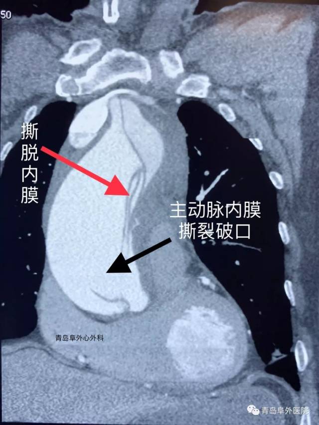 撕裂生命的主动脉夹层(图文)