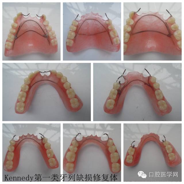 肯氏第一类牙列缺损修复体