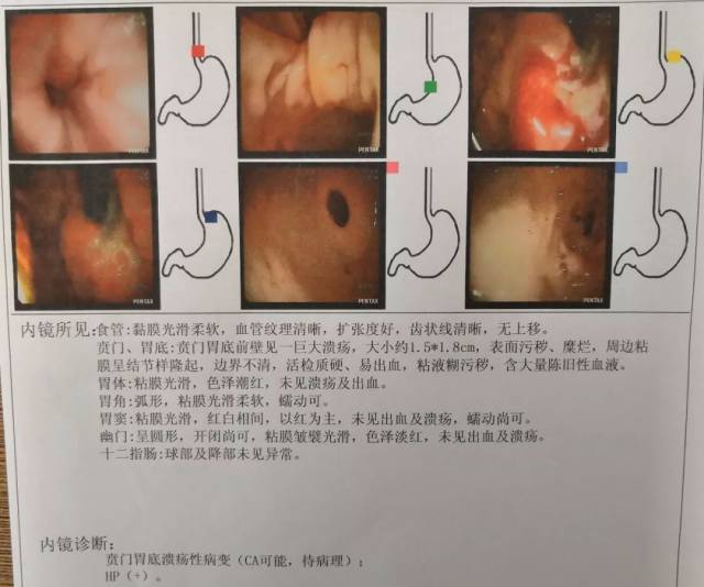 徐大伯的胃镜检查报告单