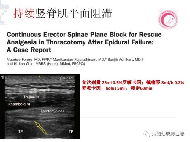 超声引导下竖脊肌平面阻滞的临床应用