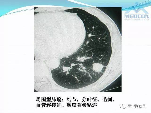 "肺炎型"肺癌的ct表现及病理学基础 | 影像天地