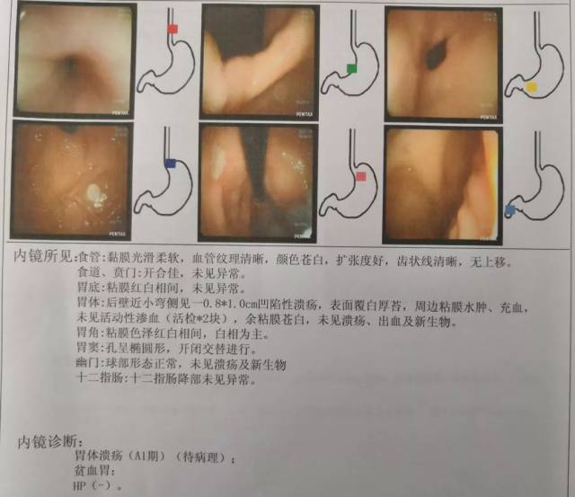 胡阿姨第一次胃镜报告单