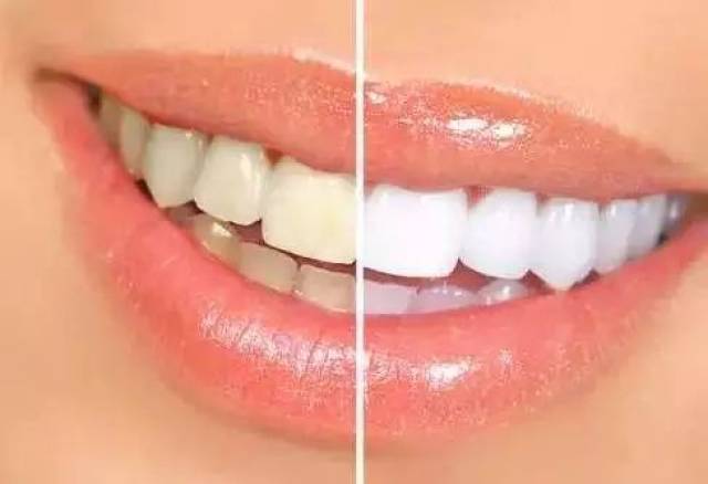 牙齿不整齐,做瓷贴面能达到很好的效果吗?