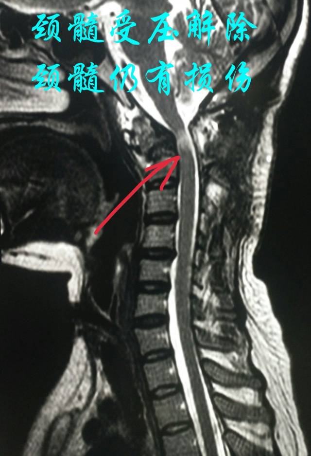 颈椎磁共振提示颈髓受压解除