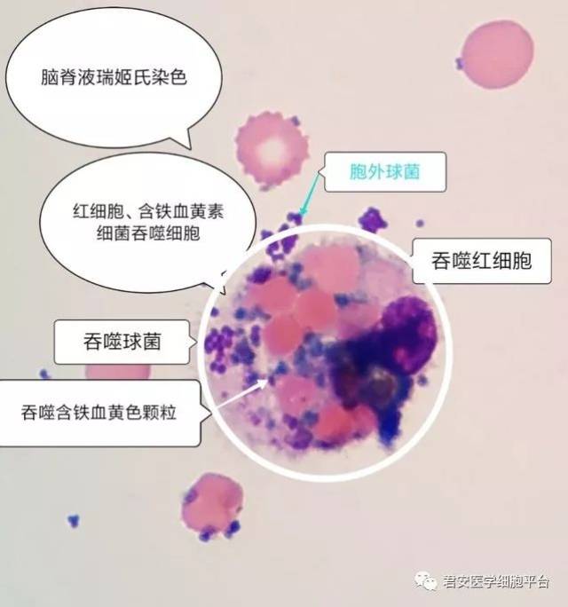 【重磅干货】脑脊液标本检验技术与病例分析