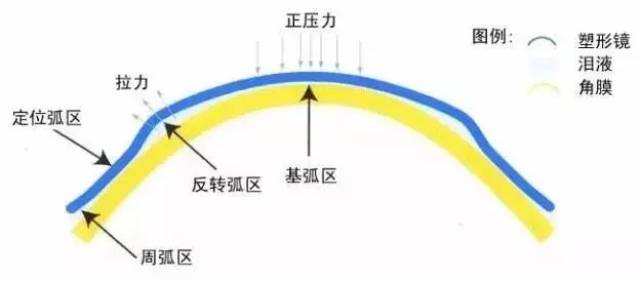 【体验】咱家的ok镜很ok!话说角膜塑形镜