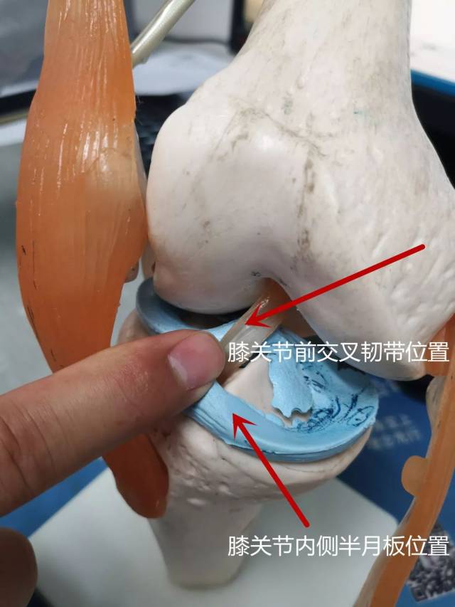 小李有90%的可能性是右膝关节前交叉韧带断了或半月板损伤,建议他住院