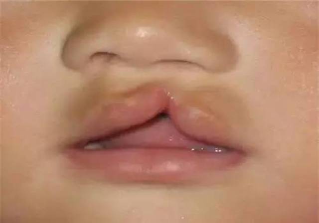 导致宝宝兔唇的原因究竟有哪些呢?