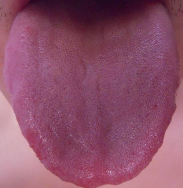 中医认为瘦簿舌是多是阴虚火旺,导致舌体不能充盈而